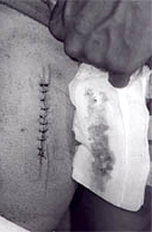 Ben's stitches
